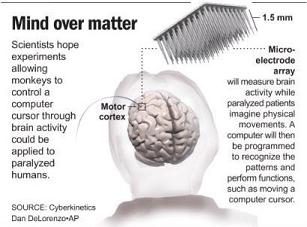 Brain implant (JPG)