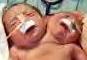 Two-headed babies (JPG)